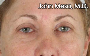 Eyelid Surgery results in NYC with Dr. Mesa