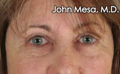 Eyelid Lift Surgery Before & After Gallery - Patient 6371334 - Image 2