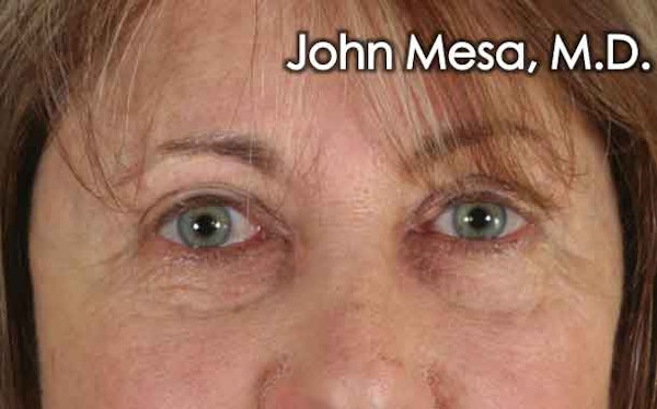 Eyelid Surgery results in NYC with Dr. Mesa