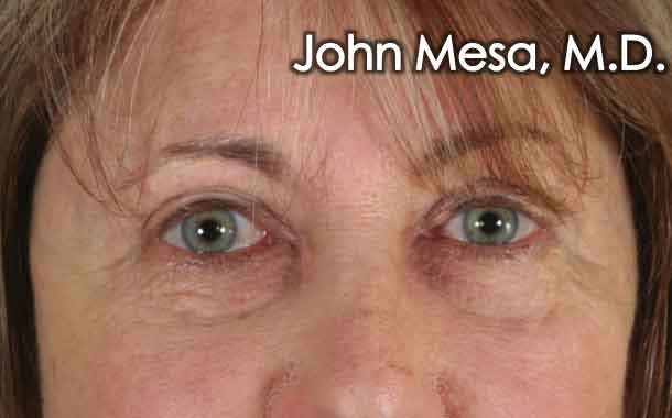 Eyelid Lift Surgery Before & After Gallery - Patient 6371334 - Image 2