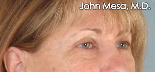 Eyelid Lift Surgery Before & After Gallery - Patient 6371334 - Image 3