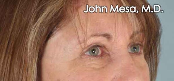 Eyelid Lift Surgery Before & After Gallery - Patient 6371334 - Image 4