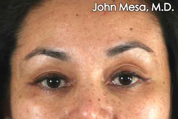 Blepharoplasty results in NYC with Dr. Mesa