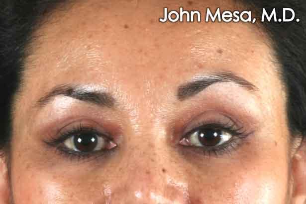 Eyelid Lift Surgery Gallery - Patient 6371336 - Image 2