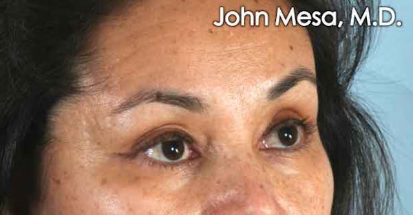 Eyelid Lift Surgery Before & After Gallery - Patient 6371336 - Image 3