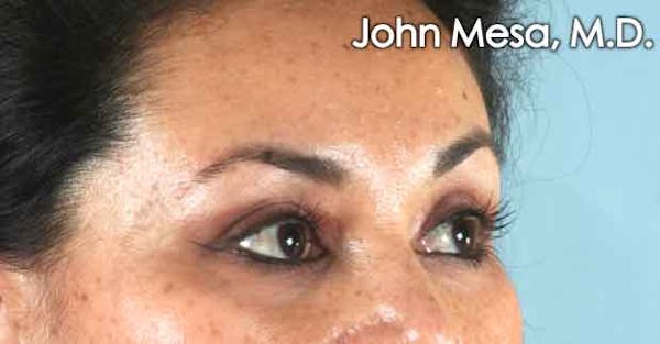 Eyelid Lift Surgery Before & After Gallery - Patient 6371336 - Image 4