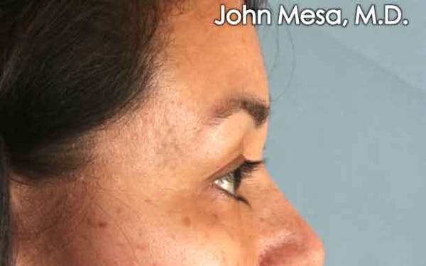 Eyelid Lift Surgery Before & After Gallery - Patient 6371336 - Image 5