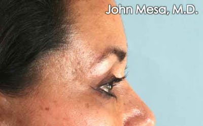 Eyelid Lift Surgery Before & After Gallery - Patient 6371336 - Image 6