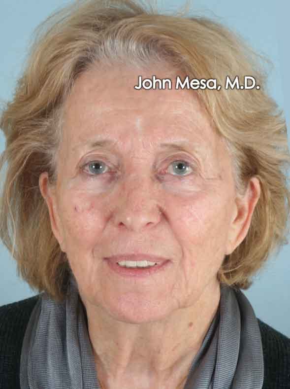 Facelift Before & After Gallery - Patient 6371339 - Image 1