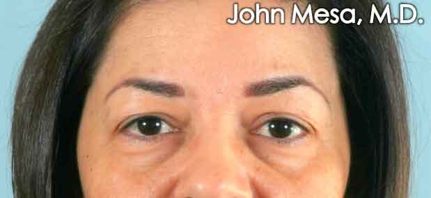 Eyelid Lift Surgery Before & After Gallery - Patient 6371337 - Image 1