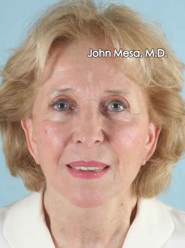 Facelift