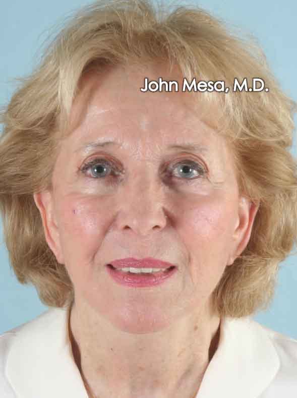 Facelift Before & After Gallery - Patient 6371339 - Image 2