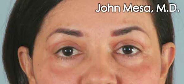 Eyelid Lift Surgery Before & After Gallery - Patient 6371337 - Image 2