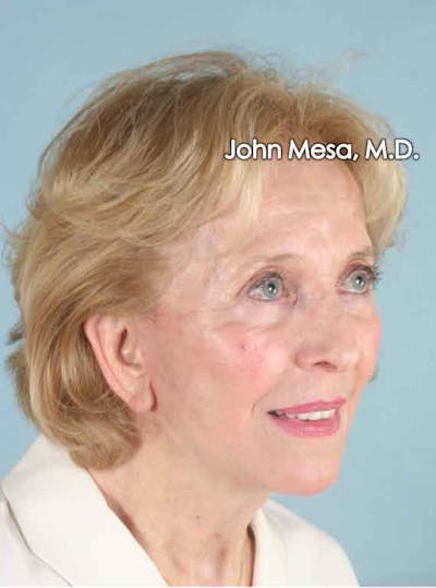 Facelift Before & After Gallery - Patient 6371339 - Image 4