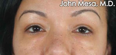 Eyelid Lift Surgery Before & After Gallery - Patient 6371338 - Image 1