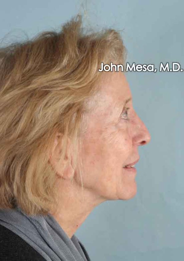 Facelift Before & After Gallery - Patient 6371339 - Image 5