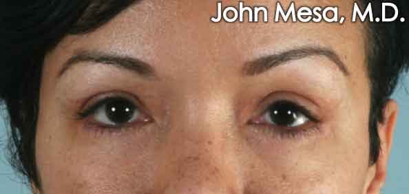 Eyelid Lift Surgery Before & After Gallery - Patient 6371338 - Image 2
