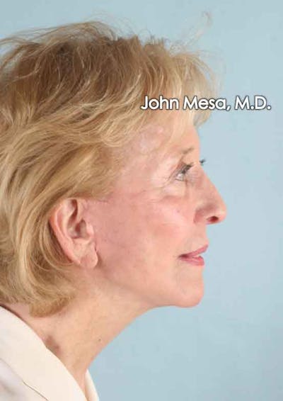 Facelift Before & After Gallery - Patient 6371339 - Image 6