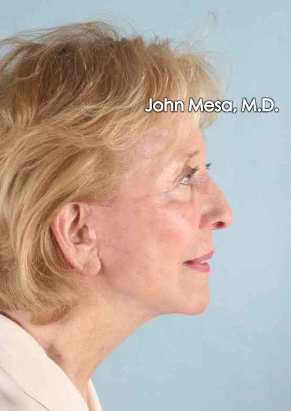 Facelift Before & After Gallery - Patient 6371339 - Image 6