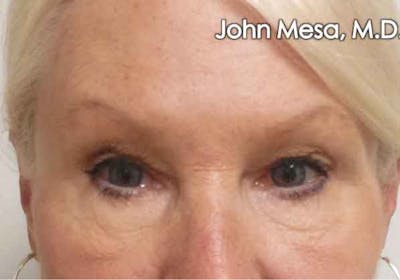 Eyelid Lift Surgery Before & After Gallery - Patient 6371340 - Image 1
