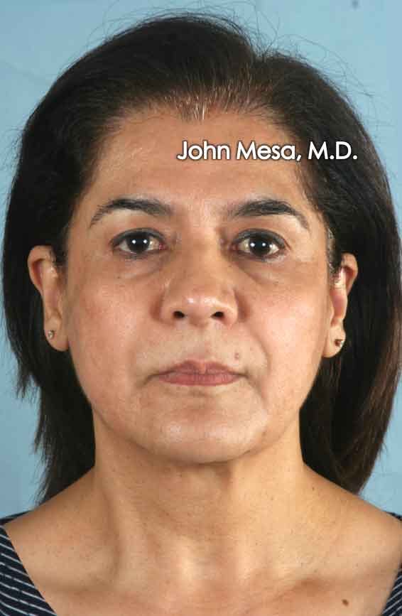 Facelift Before & After Gallery - Patient 6371342 - Image 1