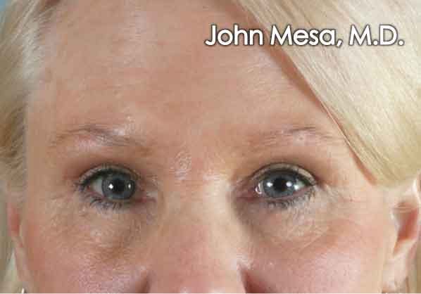 Eyelid Lift Surgery Before & After Gallery - Patient 6371340 - Image 2