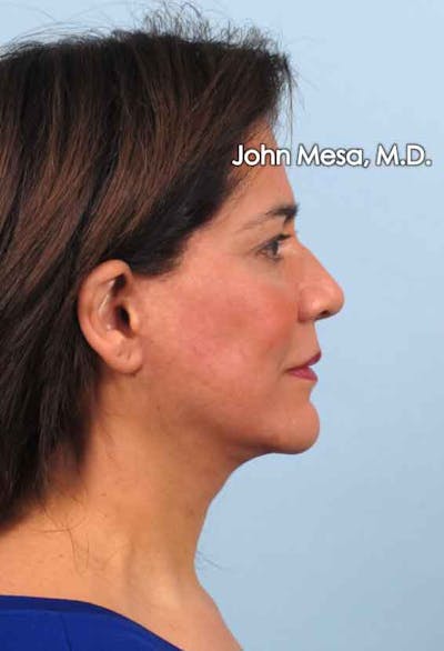 Facelift Before & After Gallery - Patient 6371342 - Image 6
