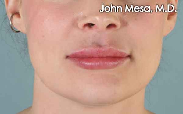 Lip Augmentation Before & After Gallery - Patient 6371343 - Image 2