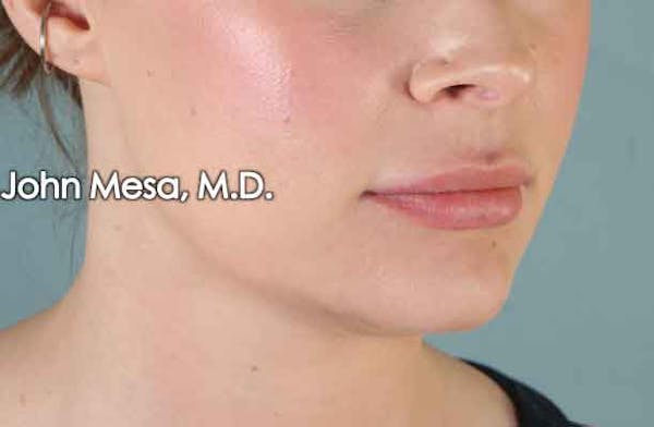 Lip Augmentation Before & After Gallery - Patient 6371343 - Image 3