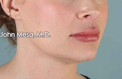 Lip Augmentation Before & After Gallery - Patient 6371343 - Image 4