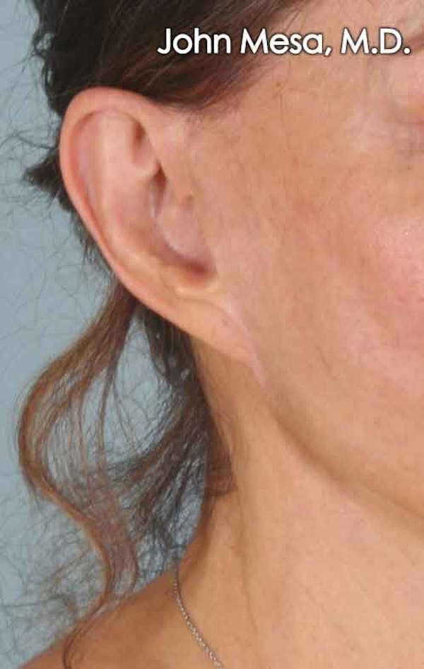 Otoplasty Before & After Gallery - Patient 6371360 - Image 1