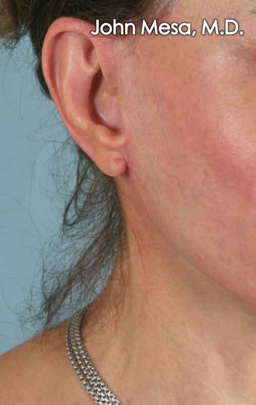 Otoplasty Before & After Gallery - Patient 6371360 - Image 2