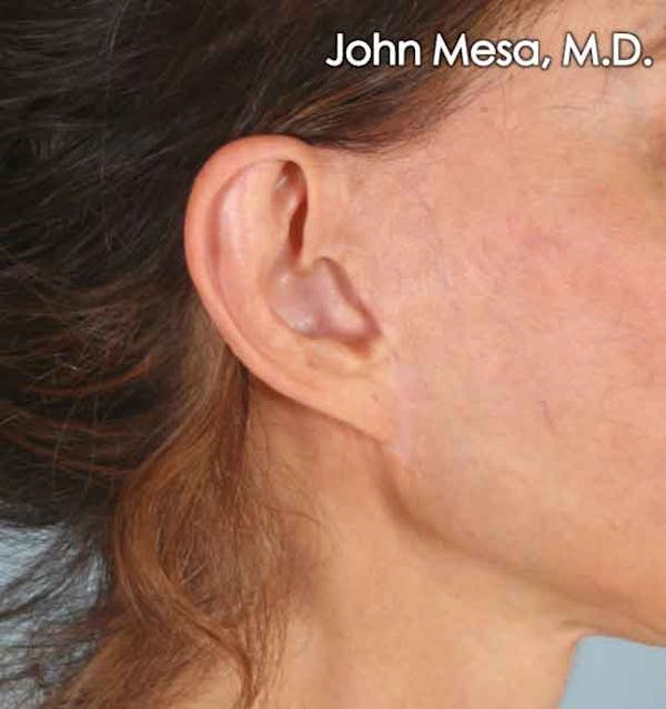 Otoplasty Before & After Gallery - Patient 6371360 - Image 3
