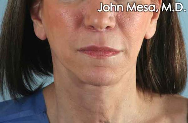 Upper Lip Shortening Before & After Gallery - Patient 6371361 - Image 2
