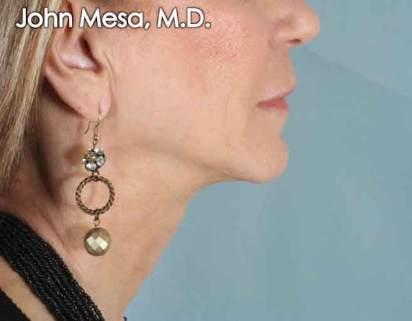 Upper Lip Shortening Before & After Gallery - Patient 6371361 - Image 3
