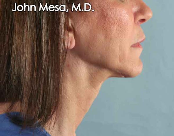 Upper Lip Shortening Before & After Gallery - Patient 6371361 - Image 4