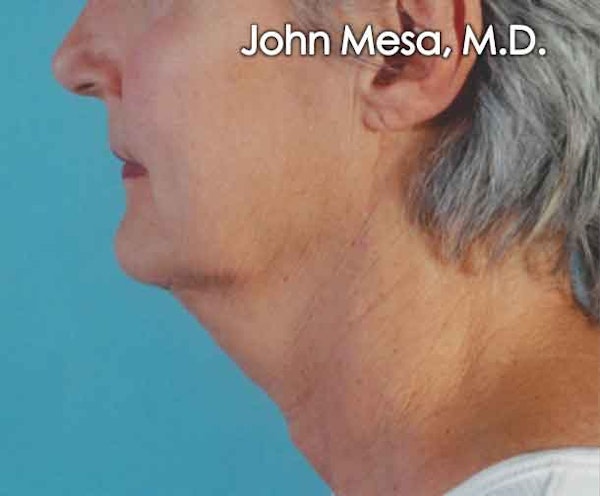Neck Lift