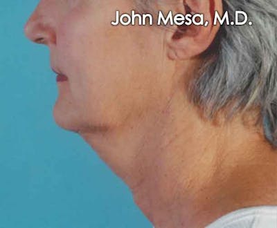 Neck Lift Before & After Gallery - Patient 6371365 - Image 1