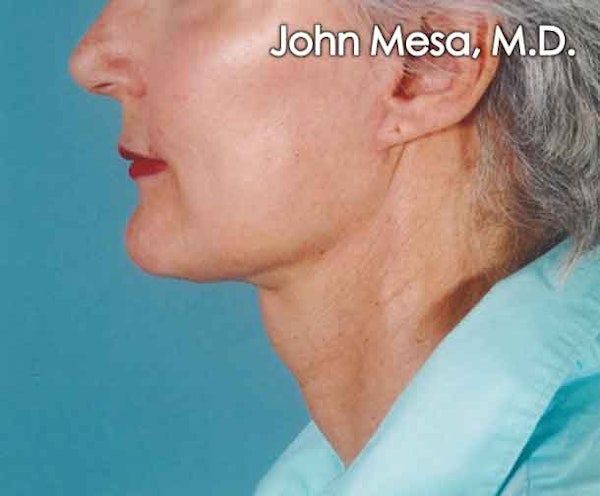 Neck Lift