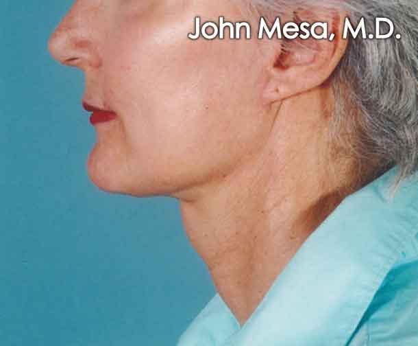 Neck Lift Before & After Gallery - Patient 6371365 - Image 2