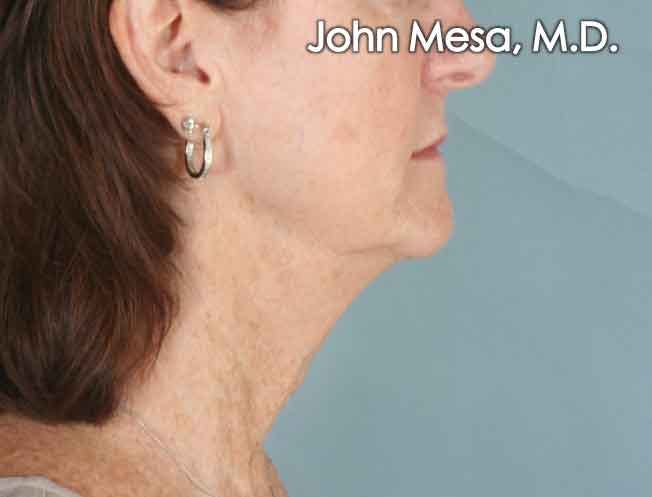 Neck Lift Before & After Gallery - Patient 6371366 - Image 1