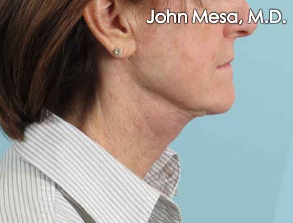 Neck Lift Before & After Gallery - Patient 6371366 - Image 2