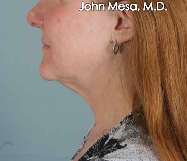 Neck Lift Before & After Gallery - Patient 6371368 - Image 1