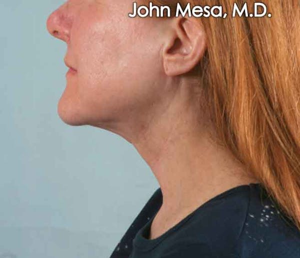 Neck Lift Before & After Gallery - Patient 6371368 - Image 2