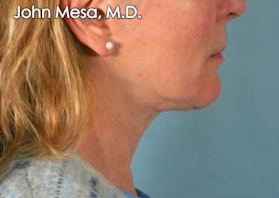 Neck Lift Before & After Gallery - Patient 6371369 - Image 1