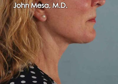 Neck Lift Before & After Gallery - Patient 6371369 - Image 2