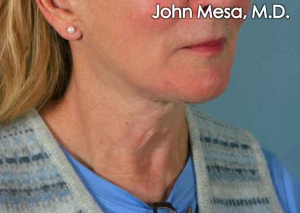 Neck Lift Before & After Gallery - Patient 6371369 - Image 3