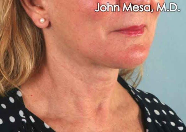 Neck Lift Before & After Gallery - Patient 6371369 - Image 4