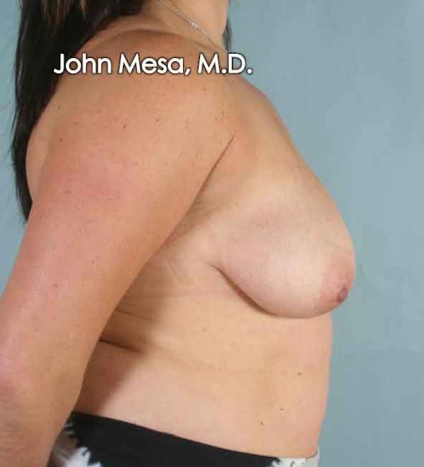 Breast Augmentation and Lift Before & After Gallery - Patient 6371447 - Image 3