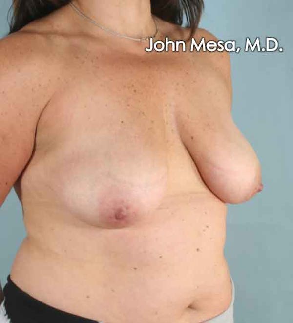 Breast Augmentation and Lift Before & After Gallery - Patient 6371447 - Image 5